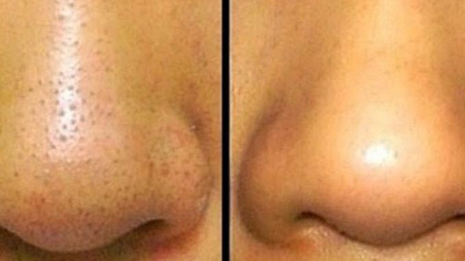 Trik koji garantovano pali: Riješite se mitesera s cijelog lica za deset minuta