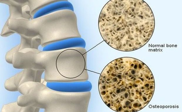 Nemojte dozvoliti da vas lažu, za osteoporozu postoji prirodni lijek…
