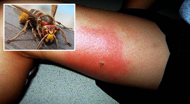 DOBRO JE ZNATI: Kada vas ubode osa, stršljen ili pčela – ovo će vas spasiti bola i otoka