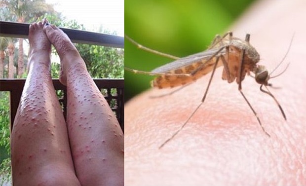Komarci su mi UNIŠTILI LJETO: Ali kad sam naučila OVAJ TRIK – nikada me više nije ugrizao NIJEDAN