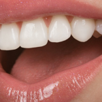 Uklonite Kamenac, Izbelite Zube I Osvežite Dah: Sve To U Samo 4 Koraka, A Sastojke Imate Kod Kuće