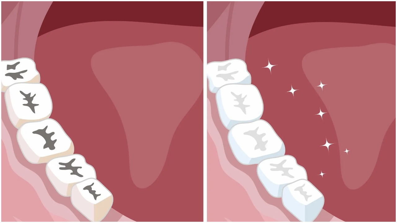 8 prirodnih načina za zaštitu zubi i liječenje karijesa